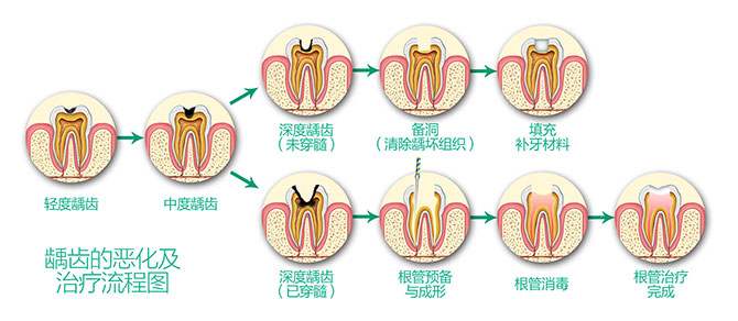 上海口腔医院牙齿有个洞补牙多少钱
