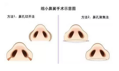上海做鼻头鼻翼缩小效果好吗