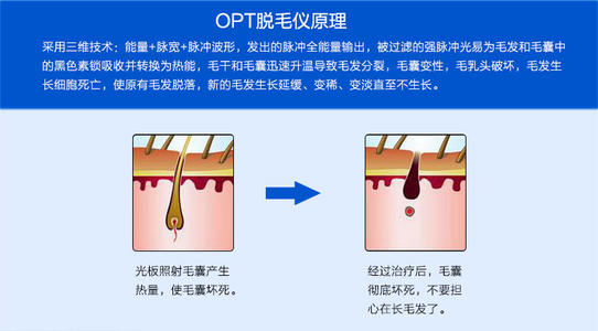 激光脱毛技术上海美莱好不好