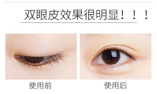 <a href='/' target='_blank'><u>上海美莱</u></a>整形美容医院双眼皮手术成功吗