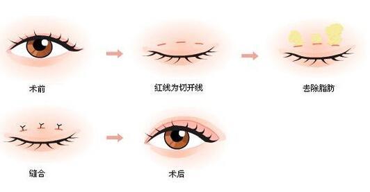 上海美莱整形美容医院双眼皮手术成功吗