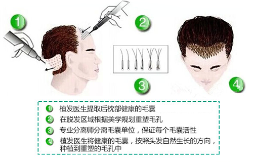 种植头发一般要多少钱在上海