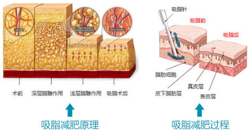 [上海美莱快速吸脂]不用饿肚子 躺着就能立刻瘦!