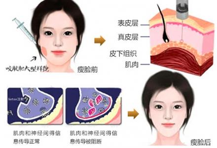 上海的正规医院注射瘦脸多少钱