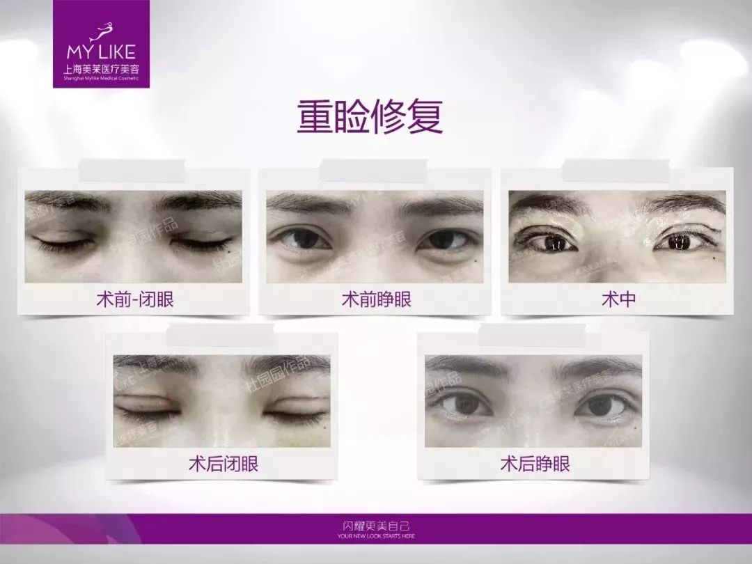 上海眼睛做宽了修复,找准医院重修自然美眼