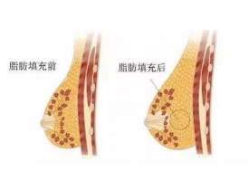 上海自体脂肪移植隆胸一般多少钱