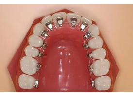 舌内侧牙齿矫正费用大概是多少，矫正效果好吗