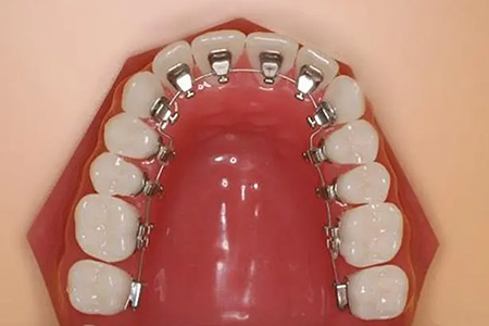 牙齿矫正治疗需要多久时间