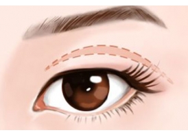 割双眼皮大概多久能恢复正常，注意事项有哪些