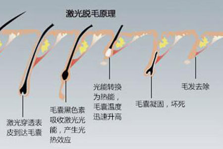 上海做激光脱毛有哪些优势