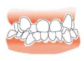 牙齿地包天的矫正方法有哪些