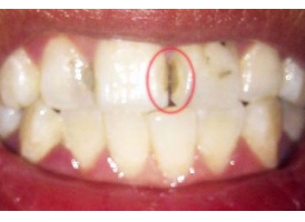 门牙蛀牙可以修复吗，蛀牙补牙需要多少钱
