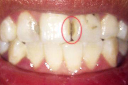 门牙蛀牙可以修复吗
