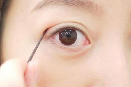 双眼皮手术方法哪种好